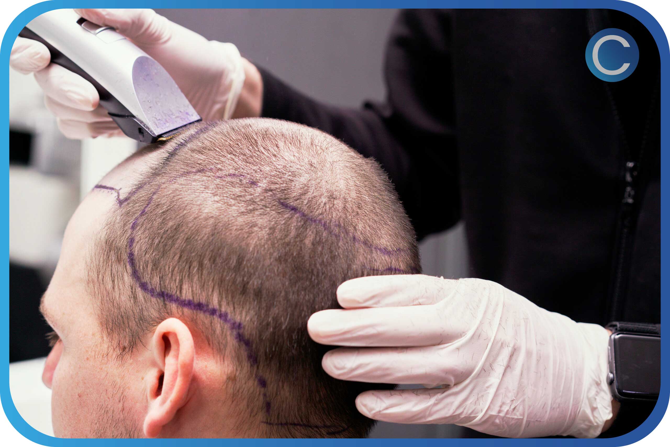 Capital Hair Center - Hair Transplant Turkey Capital Hair Center - Hair Transplant Turkey
