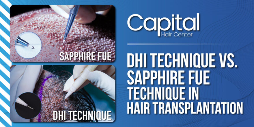DHI Technique vs. Sapphire FUE Technique in Hair Transplantation