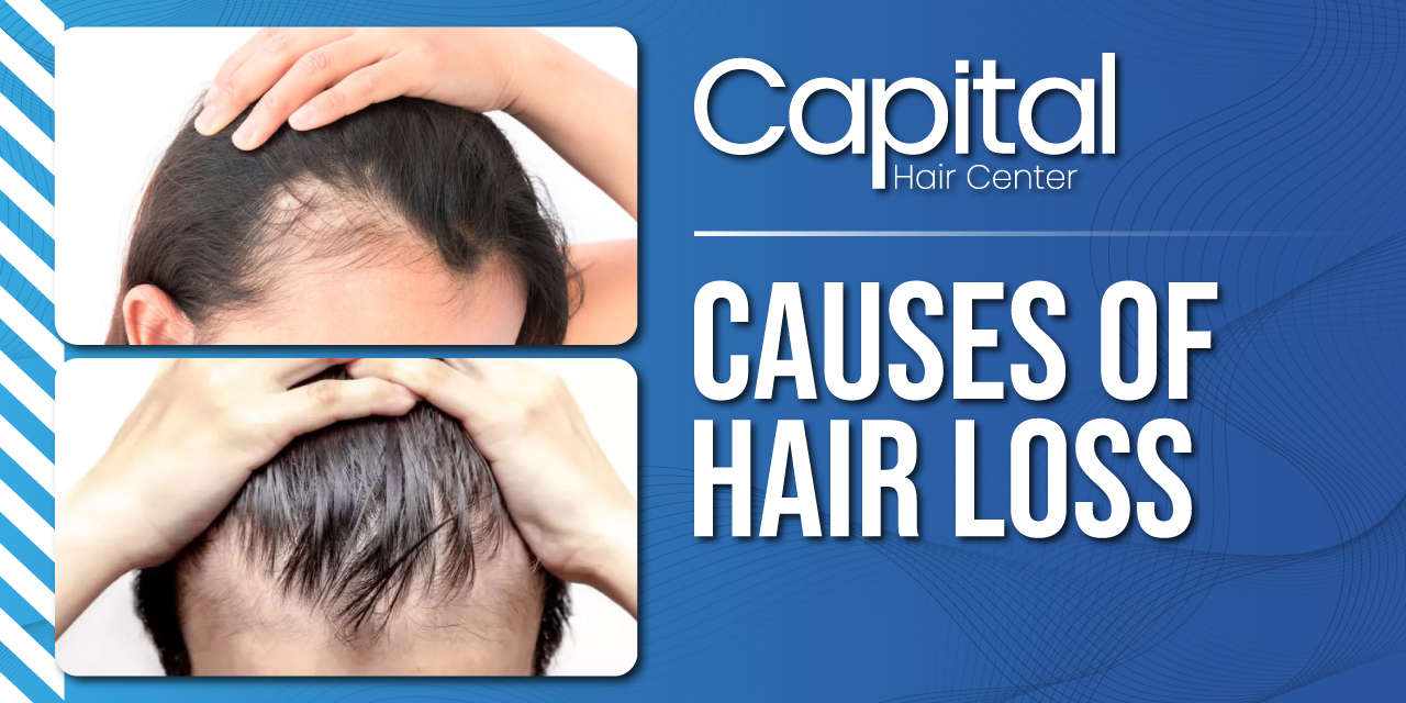 Hair Loss | What Could Lead to Hair Loss? | Hair Transplant Turkey