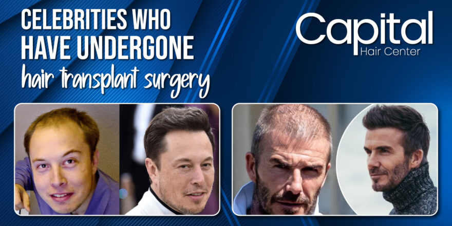 Celebrities Who Had a Hair Transplant Operation