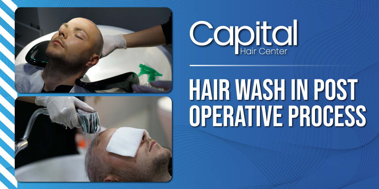 Hair Wash in Post Operative Process - Hair Transplant Turkey