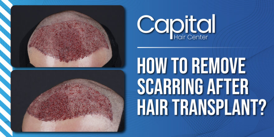 How to Remove Scarring after Hair Transplant?
