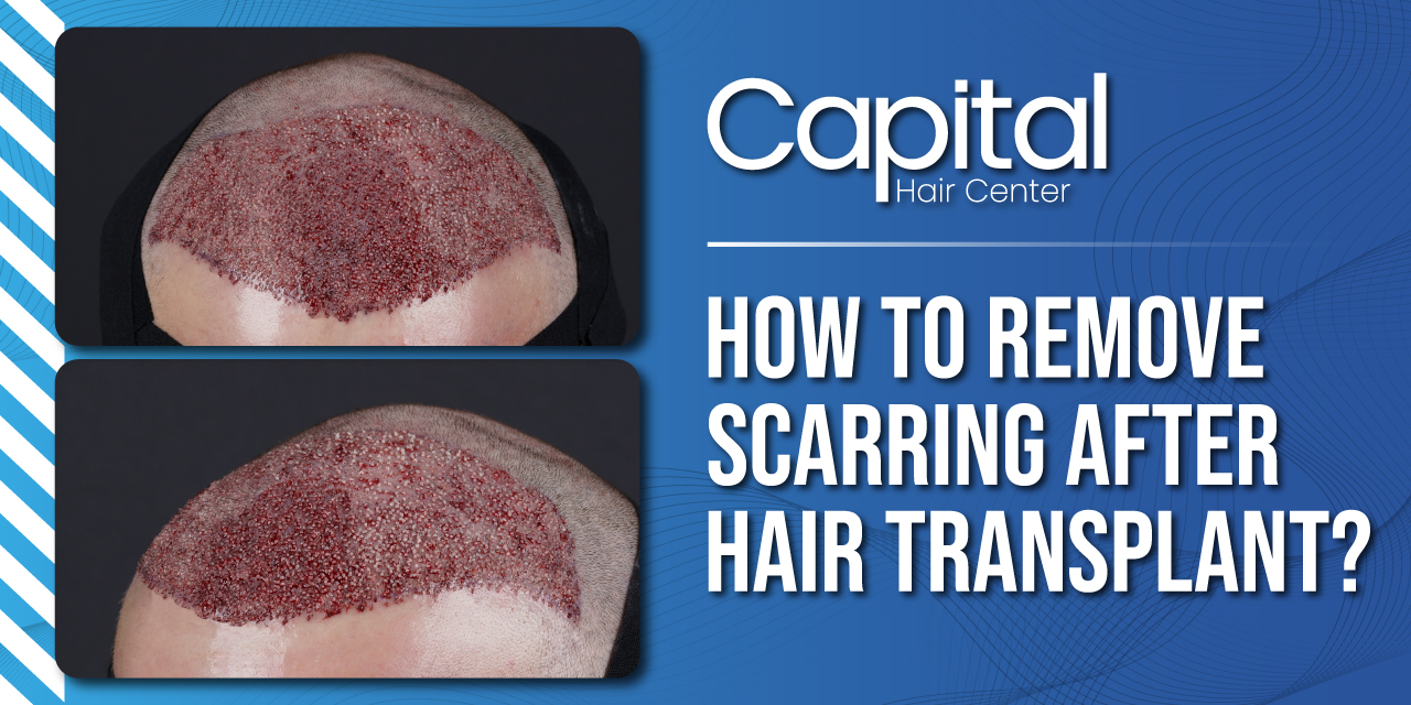 How to Remove Scarring after Hair Transplant? - Hair Transplant