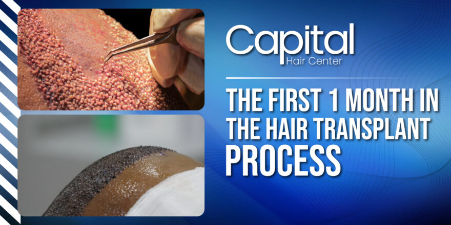 Things to Do and Don't in the First 1 Month in the Hair Transplantation Process