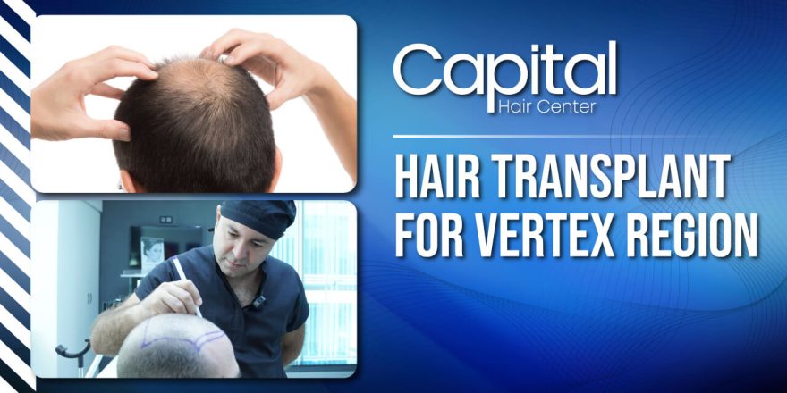 hair transplant for vertex region