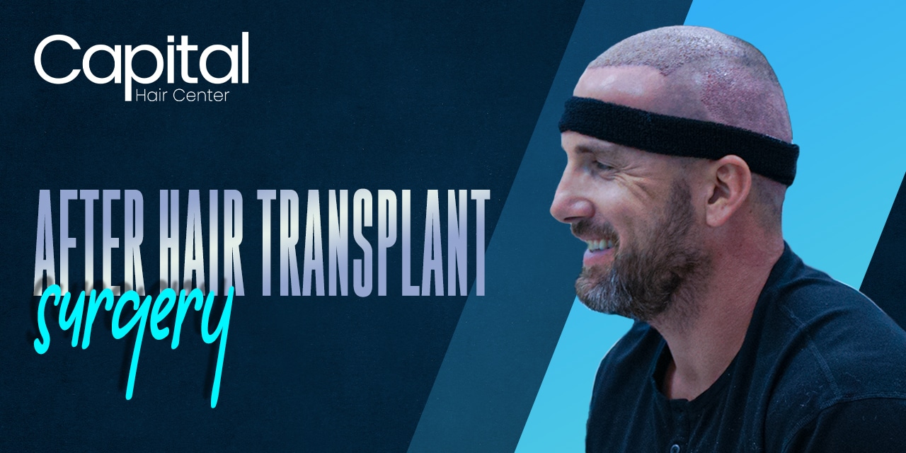 How Long Does a Hair Transplant Last  Hair Transplant Clinic Ireland