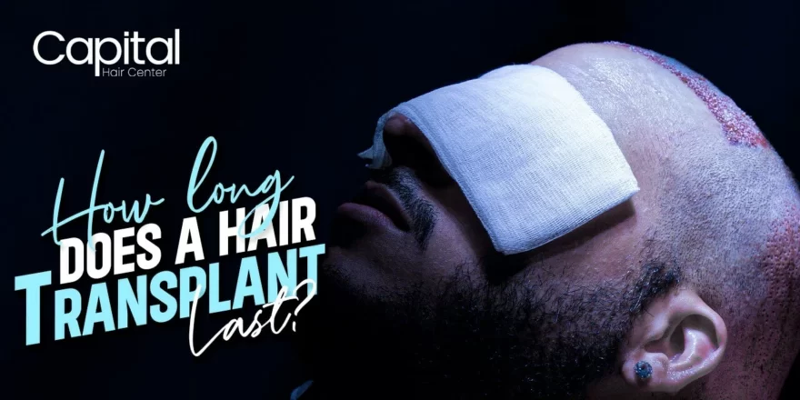 How Long Does A Hair Transplant Last?