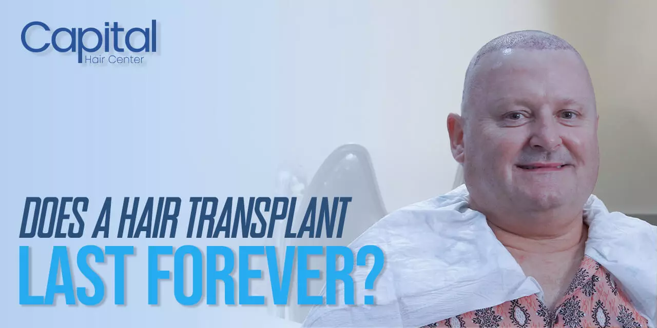 Does a Hair Transplant Last Forever?