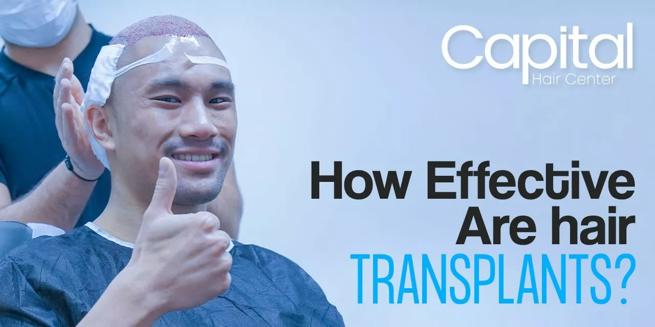 How Effective Are Hair Transplants?