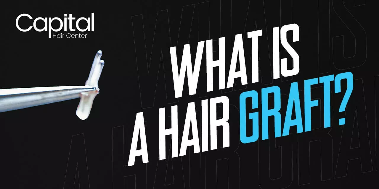 What Is A Hair Graft?