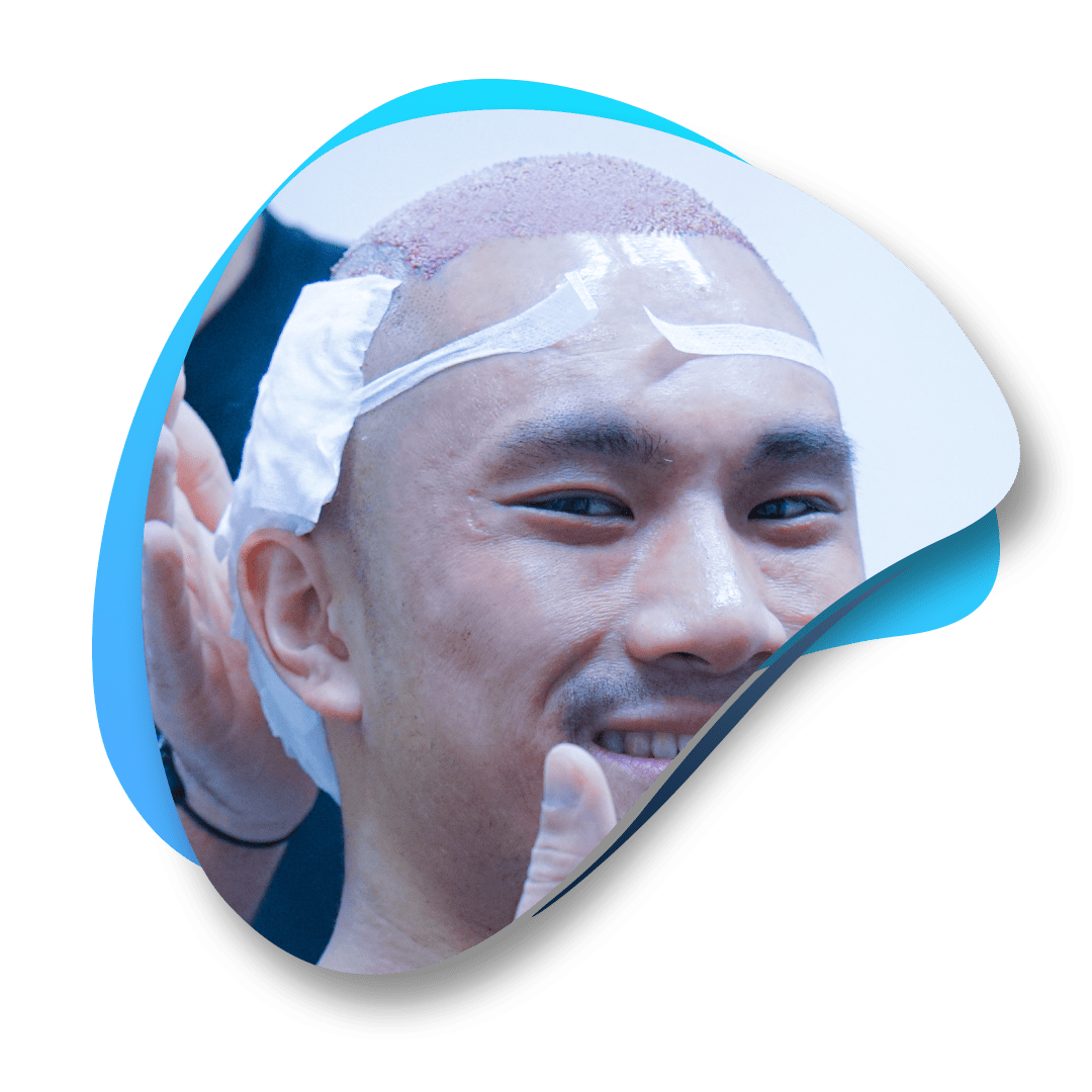 Scalp Care After Hair Transplant